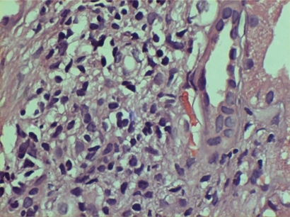 Figure 3 Acute on chronic tubulo-interstitial nephritis with mesangioproliferative glomerulonephritis.