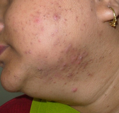 Figure 1 Inflammatory papules, deep-seated nodules and comedones on the lower cheek, mandibular area, extending to the neck in an obese perimenopausal woman.
