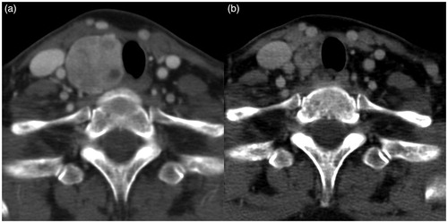 Figure 4. Contrast-enhanced CT images obtained (a) before and (b) after two radiofrequency ablation sessions (interscan interval: 4.5 years) for a 50-year-old woman with a benign nodule in the right thyroid gland. The volume reduction rate was high (65.5%). Normalization of adjacent structures, including an increase in the tracheal area (4 mm2) and anterior neck angle (20°), a decrease in the ratio of anteroposterior/transverse diameter of the trachea (0.31), and a reduction in midline deviation of the trachea (2.3 mm), could be observed.