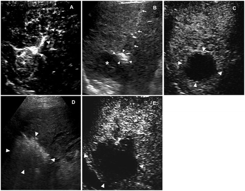 Figure 4. Images in a 41-year-old male with recurrent HCC measured 3.2 cm in diameter. (A) one feeding artery (arrowhead) of the tumor (asterisk) was depicted in the early arterial phase of 2D-CEUS. (B) FAA created a small ablation zone (arrowhead) using 1 cycle and 4 min cauterization mode. The target tumor was generally intact (asterisk). The arrow showed the electrode inserting path. (C) Immediate 2D-CEUS after FAA showed complete non-enhancement within the contour of the tumor in the arterial phase, which was identified as a complete perfusion response to FAA. (D) Hyperechoic area covered the tumor (arrowhead) after RFA, using two electrodes with a switch controller, 16 min in total. (E) 2D-CEUS performed in 30 min after RFA showed a large ablation zone measuring 5.2 cm × 4.2 cm without residue. FAA: feeding artery ablation; CEUS: contrast-enhanced ultrasound.