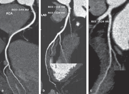 Fig. 1. Curved planar reformation images of coronary CT angiography using iomeprol 400 are shown in a 47-year-old male. The attenuation numbers using the region of interest technique of the proximal portion of the coronary arteries were higher than 500 HU for the proximal right coronary artery (a), the left main coronary artery and the proximal left anterior descending branch (b), the proximal left circumflex artery (c). On subjective analysis, 13 segments of the coronary arteries were assessed as grade 1 (posterolateral and posterior descending branch of left circumflex artery were not found).