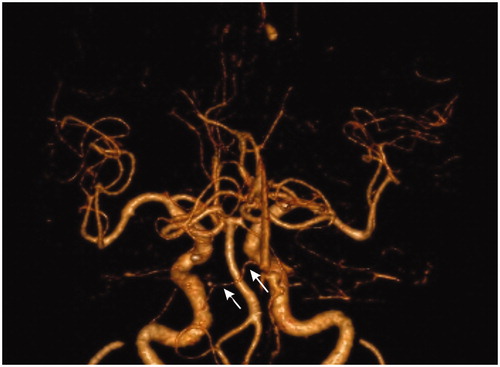 Figure 2. Coronal CT angiography and 3D reconstruction: symmetric opacification of AICA. No occlusion is shown.