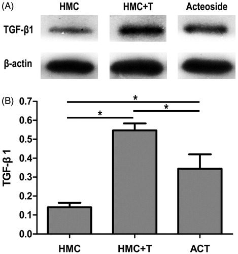 Figure 3. ACT suppresses the synthesis of TGF-β1. CD4+ T lymphocytes of patients with IgAN are co-cultured with HMCs for 5 days. ACT (40 mM) is applied to regulate inflammatory response. (A) TGF-β1 protein levels in HMCs are analyzed by Western blot. (B) Bars represent the concentration of TGF-β1 in HMCs (n = 5). * represents p < .01.