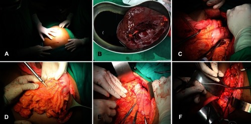 Figure 4 Step by step the operation. Left subcostal incision (A); splenectomy (B); transection and end-to-end anastomosis of the lower esophagus (C); devascularization of the upper 2/3 of the major gastric curvature (D); pyloroplasty (E); proximal splenorenal shunt (F).
