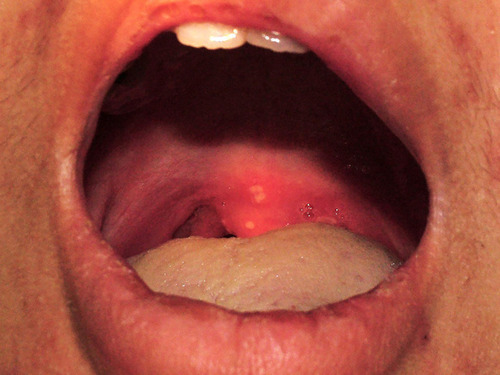 Figure 3 Recurrent oral ulcers at the uvula and tonsil.