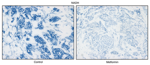 Figure 12 Treatment with metformin (a complex I inhibitor) validates the specificity of NADH activity staining in human epithelial cancer cells. Frozen sections of human breast cancer samples were subjected to NADH activity staining (blue color) in the presence or absence of metformin. However, slides were not counter-stained with nuclear fast-red (pink color), and were mounted without counter-staining, to better visualize the blue reaction product. Note that meformin (1 mM; a Complex I inhibitor) effectively abolished the NADH activity staining, directly demonstrating high-specificity. Original magnification, 40x.