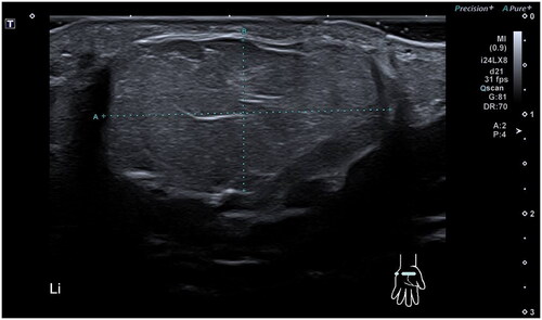 Figure 2. Ultrasound cross-section of the lipoma.
