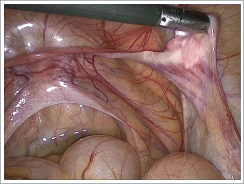 FIGURE 1. Patient with 45,X/46,XY mosaicism, laparoscopy. The right gonad contains a whitish fibrous streak cord and dysgenetic testicular structure. Persistent Mullerian ducts derivates detected: Fallopian tube, rudimental uterus.