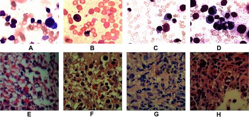 Figure 2 Images A & E, B & F, C & G, and D & H show the initial, second, third and fourth bone marrow (BM) aspirate cells smear.(H & E X400) and biopsy pathological tests (H & E X200) respectively. Cells characters: (A) (12/25/2015) Hematopoietic hyperplasia; Mature lymphocytes at 87%; Background trilineage hematopoiesis was reduced with normal morphology (E) (12/25/2015) Hematopoietic area at 90%. Abnormal cells increased in number, containing a large cell body, a moderate amount of cytoplasm, round or oval nucleus. MF-1 level. (B) (03/31/2016) Hematopoietic hyperplasia;Mature lymphocytes at 21%. Iron stain positive Sideroblasts were 35% of all normoblasts. Erythroid series revealed numerous proerythroblasts and basophilic erythroblast (56%), with abnormal nucleus easily observed (<10%). Myeloid and megakaryocyte were reduced. (F) BM biopsy (03/31/2016) demonstrated Hematopoietic area at 90%. A marked increase in granulocyte and immature erythroid cell and small megakaryocytes. Immunohistochemistry showed CD42b megakaryocytes(+); CD34(-);CD117, CD5, MPO, CD20andCD23 (scattered or clustered+). MF-1 level. (C) (05/11/2016) Hematopoietic hyperplasia Mature lymphocytes at 15%. Sideroblasts were 10% of all normoblasts. Erythrocytes were active. Parts of erythroblasts were megaloblastic (<10%). Myeloid hyperplasia was reduced. (G) (05/11/2016) BM biopsy showed increased fibrosis, and granulocyte, erythrocyte, and megakaryocyte cells were easily observed. Lymphocytes were focally or dispersedly distributed. Immunohistochemistry revealed abnormal B cells had increased in quantity, reacting positively for CD20, CD5, CD23, and 42b megakaryocytes, CD34 (<2%), CD117 (a small amount), MPO (a small amount), but negative for CD3 Remarkable fibrous proliferation (MF-2 level). Small megakaryocytes were easy to see. Immunohistochemistry revealed the number of abnormal B cells increased, positive for CD20, CD5, CD23; CD42b megakaryocytes(+); CD34 (<2%); CD117 (a small amount); MPO (a small amount); CD3(-). (D) (06/13/2016) Hematopoietic area at 80%. A significant increase in the amount of large body cells with abundant cytoplasm, round or slightly irregular nucleus, thicker nuclear chromatin, and prominent nucleoli, IHC showed negative for CD20, PAX5, CD3, CD138, CD117, CD42b, Ckpan, Cam5.2. Small lymphocytes increased in number and were positive for CD20, PAX5, CD5 and CD23. (H) BM biopsy showed Lymphocytes taking up 62.71% of all nucleated cells, with abnormal small mature B lymphocyte at 53.22%, positive for CD19, CD20 (a small amount), CD22, CD23, Lambda, and negative for CD10, FMC7, CD34 and Kappa with light chain restriction. Juvenile erythrocyte and granulocyte had reduced.