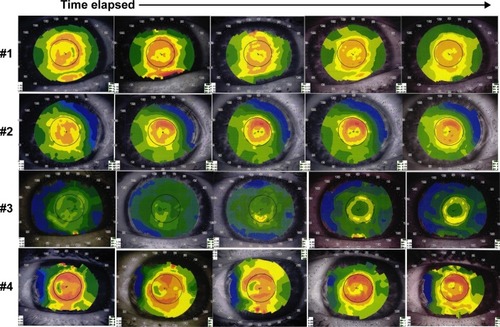 Figure 5 Demonstration of topographic pattern of annular steepening with central flattening occurring over the 36-month follow-up period with a corresponding hyperopic shift in four patients (#1–4).