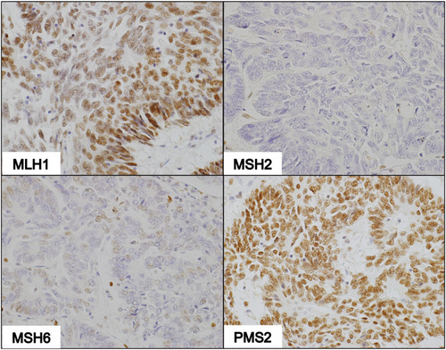 Figure 5 IHC of dMMR tumor deficient in MSH2 only. Photomicrographs demonstrate strong nuclear staining with MLH1 and PMS2, and weak staining with MSH6 in a few tumor cells in the absence of MSH2 staining (100X magnification).