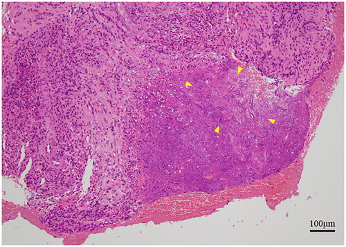 Figure 4. A Histologic examination shows septate and branched fungi (arrowhead) infiltrating the mucosal interstitium with ulcer formation (hematoxylin and eosin ×100).
