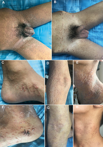 Figure 1 Clinical features of the patient. (A) At the admission time, the inguinal and scrotal scabs were accompanied by severe exudation. (B) After 6 days of treatment, the skin lesions basically subsided. (C-F) Red papules began to appear on both feet, and blisters gradually spread all over the body, except the head, face, and soles of the feet. (G, H) The patient was discharged with improved skin lesions, remaining milium and post-inflammatory hyperpigmentation.