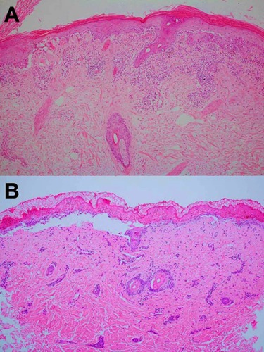 Figure 5 (A) Acute interface dermatitis demonstrating vacuolar degeneration of the epidermal basal-cell layer in lupus erythematosus–specific vesiculobullous disease (H&E, 100×). (B) Full-thickness epidermal necrosis leading into epidermal detachment in toxic epidermal necrolysis–like acute cutaneous lupus erythematosus (H&E, 100×).