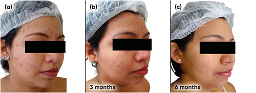 Figure 3 Case study 2 improvement on right-hand side of face, baseline to 6 months (a) Baseline (b) 3 months with AZA 15% gel twice daily (c) 6 months with AZA 15% gel twice daily.