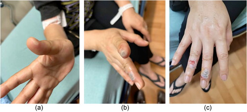 Figure 2. Photographs demonstrating multiple partial thickness burns to the (a) first digit, (b) second and third digits, and (c) third and fourth digits 2 days after exposure.