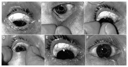 Figure 1 Steps of the TIE test. (A) Eye looking down. (B) Pinching of the lower eyelid. (C) Skin being rolled over the tarsal edge. (D) Spreading the eyelid against the eyeball. (E) The result after releasing the eyelid. (F) Stable entropion.