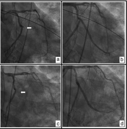 Figure 2. Coronary angiograms, right anterior oblique caudal views: (a) index angiogram showing 100% thrombotic occlusion of the second obtuse marginal artery (OM2) (arrow); (b) after PCI of OM2 with a drug-eluting stent with TIMI 3 flow; (c) 72 hours after PCI showing complete occlusion of OM2 from stent thrombosis (arrow); and (d) after repeat PCI of OM2 with a drug-eluting stent showing TIMI 3 flow.