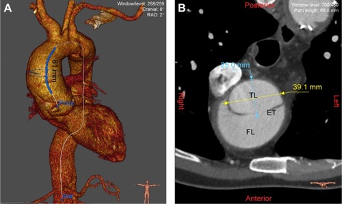 Figure 3 Aortic measurements.