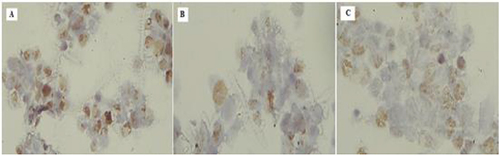Figure 7 Evaluation of PCNA protein immunohistochemical expression in HepG2 cell post treatment showing downregulation of the staining (from A to C).