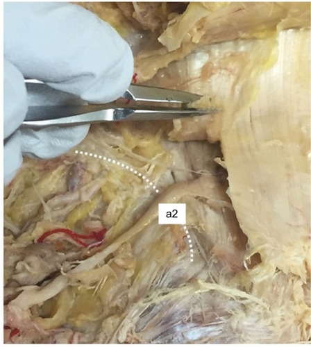 Figure 3 Photographs showing entrapped branches of the medial branch of the SCN in cadaveric specimen no. 23. a2 is the second most medial branch of SCN.