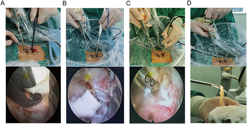 Figure 3 Various surgical instruments used in UME surgery. (A) Utilization of radio frequency probe to remove the soft tissue attached to the lamina and created a workspace. (B) High speed grinding drill was used to remove the lamina and hyperplastic facet joints. (C) Laminectomy punch was used to remove the proliferative ligamentum flavum. (D) Utilization of endoscopic nucleus pulposus forceps under coaxial spinal endoscope to remove large migrated nucleus pulposus.