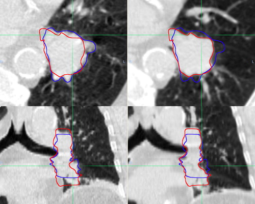 Figure 3. Illustration of significant variation in size and shape during breathing, with representative axial and coronal slices from patient 3 whose tumor showed the greatest change. CT images on left from phase 50% and on right from phase 0%. Contours from both phases are shown after rigid registration of the CT scans.