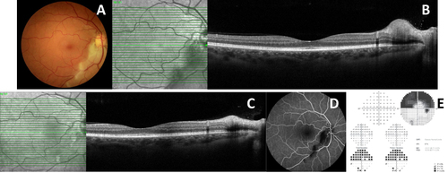 Figure 2 Case Report 2: At presentation: (A) Retinography with inferior peripapillary pallor and slight periarterial edema; (B) Macular SD-OCT showing an edema of the inner layers of the retina adjacent to the inferior temporal branch of the central retinal artery. At 1st month of symptoms: (C) Macular SD-OCT maintaining an internal retinal edema; (D) AF showing dilation of peripapillary capillaries with ischemic lesions in the inferior temporal artery (time: 1.31.48); (E) 30–2 Visual Field showing the superior scotoma with preserved macula.