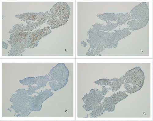 Figure 2. Immunohistochemistry of MLH-1 (A), MSH-2 (B), MSH-6 (C) and PMS2 (D) in urothelial carcinoma, 20x (cell block section, cytology) showing loss of MSH-2 and MSH-6.