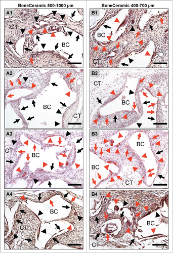 Figure 3. shows exemplary pictures of the TRAP-activity of the material-associated multinucleated giant cells adjacent to the bone substitute granules of BoneCeramic 500–1000 μm (A1 – A4) and BoneCeramic 400–700 μm (B1 – B4) on days 10 (A1 and B1), 15 (A2 and B2), 30 (A3 and B3) and 60 (A4 and B4) after implantation (TRAP-staining, 200x magnification, scale bars = 100 µm).