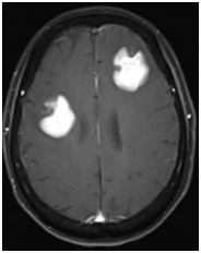 Figure 5. Brain MRI with more relapsed progressed primary central nervous system lymphoma. Brain MRI showed rapid 4th progression on post-contrast T1 image after a clinical trial therapy, at 23 months since diagnosis.