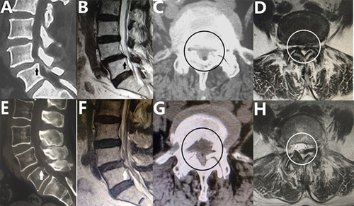 Figure 4 Pre- and postoperative CT and MRI. (A and B) The superior endplate of the inferior vertebra (arrow) before surgery. (C and D) Central spinal canal stenosis (circle). (E and F) The protruding vertebral bone was removed (arrow), and this procedure led to restoration of the original spinal canal shape. (G and H) The central spinal canal (circle) was enlarged. The superior endplate of the inferior vertebra was indicated by arrow. The central spinal canal stenosis and the enlarged central spinal canal was indicated by circle.