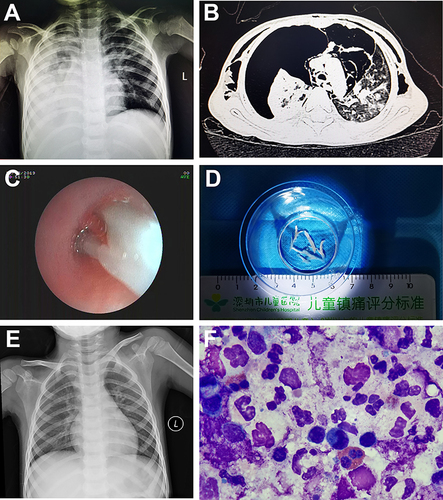 Figure 1 Representative clinical findings of an influenza patient who developed plastic bronchitis (PB). (A and B) Chest X-ray and computed tomography (CT) before bronchoscopic examination showing consolidation and atelectasis of the lungs; (C and D) Bronchoscopic examination and removal of tube-like casts is suggestive of PB; (F) Hematoxylin and eosin staining of PB showing necrotic tissues with large amounts of infiltration of white blood cells; (E) Chest X-ray after treatment showing resolution of the lung lesions.