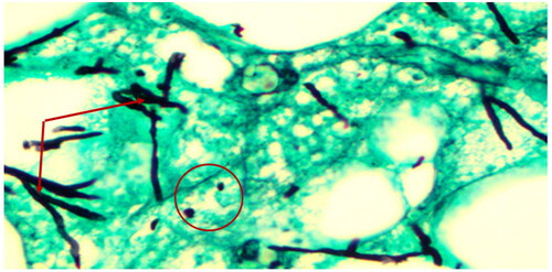 Figure 5. Photo microscopy of giraffe skin disease tissue section showing fungal spores (circle) and hyphae (arrows) which are positive for Grocott’s Methenamine-Silver special fungal staining (magnification of 10 times).