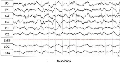 Figure 1 Electroencephalography tracing from an atypical sleep patient. F3, F4, C3, C4, O1, O2 indicate EEG lead locations.