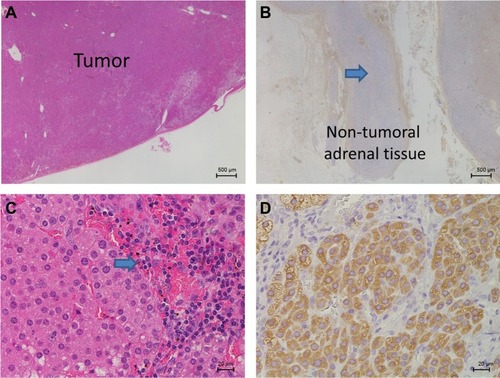 Figure 3 Histological findings of the resected left adrenal gland.