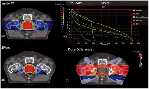 Figure 1. A representative CT slices of Patient #1. With different treatment modalities (A) ro-IMPT; (B) SPArc; (C) DVH shows the dosimetric difference between ro-IMPT (solid line) and SPArc (dashed line) indicating a significant dose reduction on all organs at risk including rectum, bladder; (D) dose difference between SPArc and ro-IMPT plans.