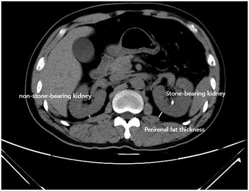 Figure 1. Axial CT scans at the level of renal hilum used for evaluating the perirenal fat thickness.