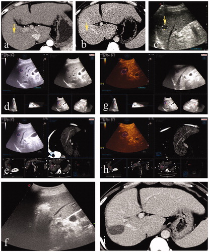 Figure 1. A 51-year-old male. (a, b) Contrast-enhanced CT indicates a liver tumor located in segment 7. Arterial enhancement and delay wash-out were observed. (c) A hypoechoic lesion in US. (d) Real-time US was successfully matched with immediately acquired preablation 3DUS. (e) Real-time US was matched with preablation CT volume images successfully. (f) Ablation was applied under the guidance and monitoring of US. (g) CEUS was performed and fused with preablation 3DUS. The ablation zone completely covered the target tumor and the 5-mm ablative margin. (h) CEUS fused with preablation CT indicated the ablation zone completely covered the target tumor and the 5-mm ablative margin. (i) Subsequent contrast-enhanced CT within three months confirmed that the tumor had been completely ablated.