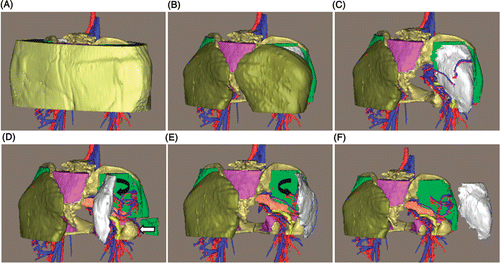 Figure 10. Preoperative surgical planning for patient 2. (A) The entire 3D model of the tumor region. (B) and (C) The 3D model with the skin, subcutaneous fat and gluteus maximus removed, respectively, along the surgical approach. (D) The simulated tumor stripping method from the lateral to the medial side can fully expose the superior and inferior gluteal vessels, the communicating branch (white arrow) and the sciatic nerve. (E) The stripping method from the medial side limits the complete exposure of the aforementioned structures. (F) The tumor is moved laterally to double-check the anatomical relationship. The simulated surgical planning can give the surgeons a firm understanding of the anatomical layers around the tumor and make them more confident during the actual operation.