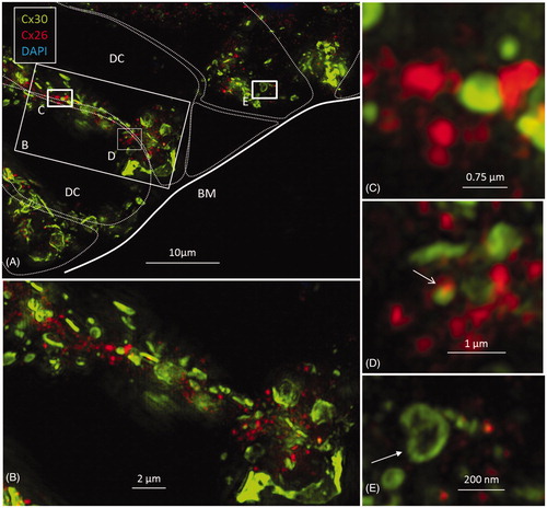 Figure 5. A: Maximum-intensity projection of Cx26 (red) and Cx30 (green) protein expression beneath the outer hair cell region of the human organ of Corti. Cx26 and Cx30 seem to be expressed separately. Cell borders are outlined. Framed areas are magnified in B–E. B and C: Cx26 is mostly expressed as small dots in close association with larger Cx30-positive plaques. D: Superimposed GJs are stained yellow (arrow). E. The Cx30-positive GJ profile (arrow) may reflect degradation and invagination of the channel plaque into the cytoplasm. BM: basilar membrane; DC: Deiters cell.