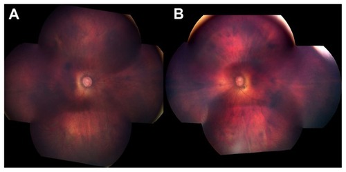 Figure 2 Fundus photographs of (A) right eye and (B) left eye.