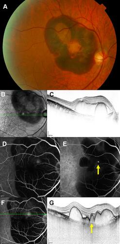 Figure 1 A representative case of a large submacular hemorrhage (SMH) secondary to polypoidal choroidal vasculopathy. (A) A color fundus photograph shows a large SMH. (B and C) Infrared reflectance and optical coherence tomography (OCT) images show the SMH and hemorrhagic retinal pigment epithelial detachment. (B) The green arrow indicates the direction of OCT scan in (C). (D and E) Fluorescein and indocyanine green angiography performed after pneumatic displacement. (E) The yellow arrow indicates a polypoidal lesion. (F and G) Fluorescein angiography and OCT images performed after pneumatic displacement. (F) The green arrow indicates the direction of the OCT scan in (G). (G) The yellow arrow indicates the polypoidal lesion.