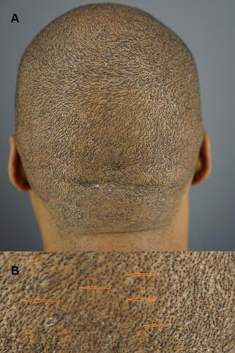 Figure 3 Example of thick/firm scalp. Patient 3 male patients of African descent. Posterior view of the scalp. Manifests features of thick-firm scalp with peau d’Orange surface and acne keloidalis nuchae – like papules in the nape area (A): close up view of a thick firm scalp showing a peau d’Orange surface with recessed (pitted) hair exit points (orange arrows) (B).