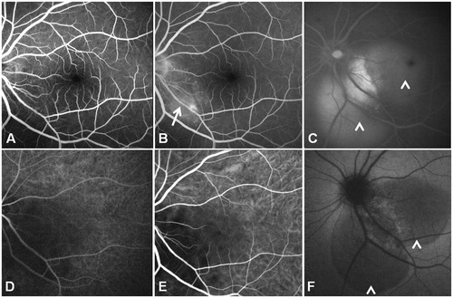 FIGURE 2. Fluorescein angiography of the left eye (A) shows a juxtapapillary hyperfluorescent lesion (arrow) with late (B, C) leakage (arrowheads) and a slight decrease in the caliber of the lower temporal artery (arrow). Indocyanine green angiography (bottom panel) shows the lesion as hypofluorescent in the early phase (D), characterized by inhomogeneous late (E, F) staining on its borders.