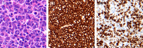 Figure 2. The tumor is histologically composed of large, blastic transformed cells with predominately diffuse growth pattern (a) (HE stain × 40). The neoplastic cells are immunoreactive for B-lymphocyte marker CD20 (b) (× 20). Ki67 staining shows a proliferation fraction > 40% (c) (× 20).