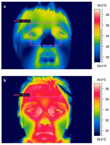 Figure 1. Two 10-year-old males, the top thermogram (a) shows a healthy (non-febrile) case. The bottom thermogram (b) shows a case of fever. Thermogram A shows a max temperature of 35°C at the inner eye-canthus. Thermogram B shows a max temperature of 38.6°C at the inner eye-canthus. Figure adapted with permission of QIRT Council [Citation24]