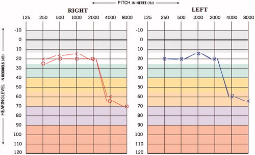 Figure 2. Post-medication audiogram of case 1.