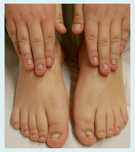 Figure 7. Pachyonychia congenita.Nail lesions in a 7-year-old boy. All nails show mild thickening with distal onycholysis and subungual hyperkeratosis.