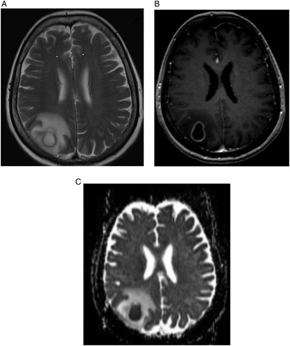 Figure 1. T2-weighted (A) and post-contrast T1-weighted (B) brain MR images in the axial plane shows a right parietal mass lesion, with ring enhancement and peripheral edema. Apparent diffusion coefficient map (C) generated from diffusion-weighted study performed at the same anatomic level depicts diffusion restriction, reflecting the highly viscous content, consistent with abscess.